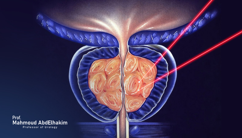 Laser prostatectomy