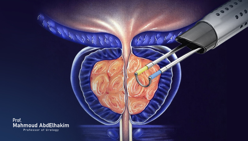 Bipolar prostatectomy