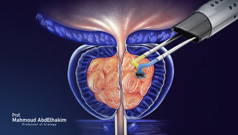 Plasma vaporization for BPH