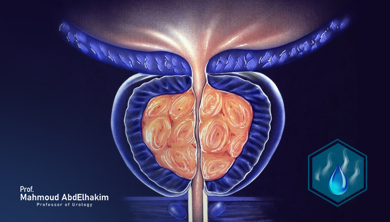 علاج تضخم البروساتا